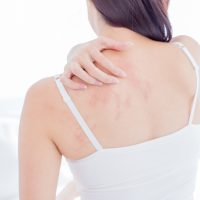 あせも・かゆみで眠れない…！夏の肌トラブルの原因と対策