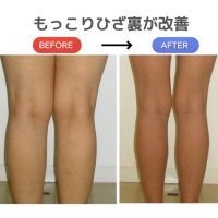 【美脚への道】ひざ裏の“もっこり”が気になる人へ！すっきり見せる簡単ケア